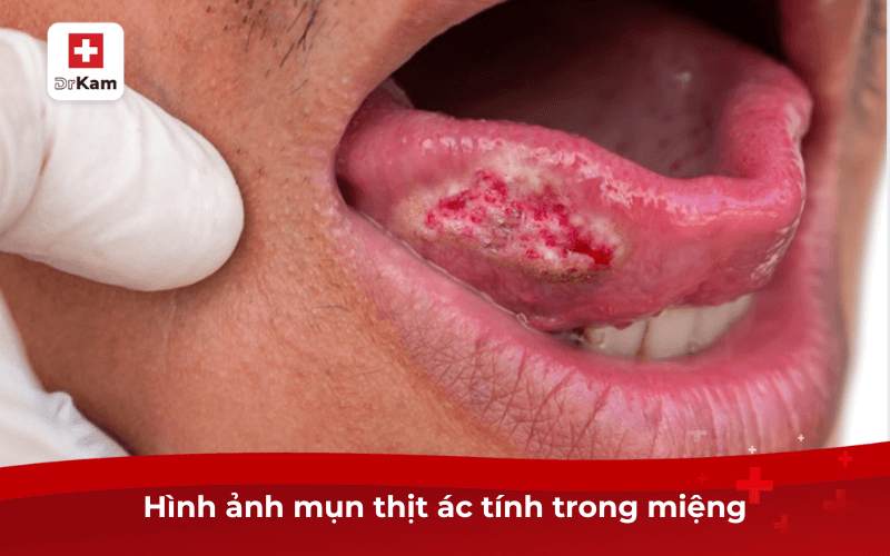 Hình ảnh mụn thịt ác tính trong miệng