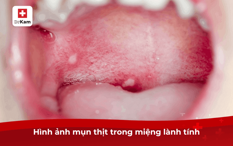 Hình ảnh mụn thịt trong miệng lành tính