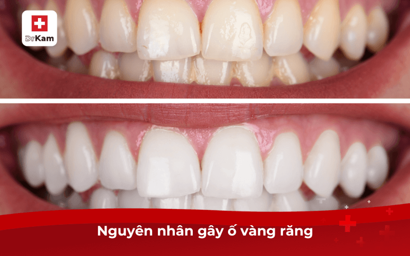 Nguyên nhân gây ố vàng răng