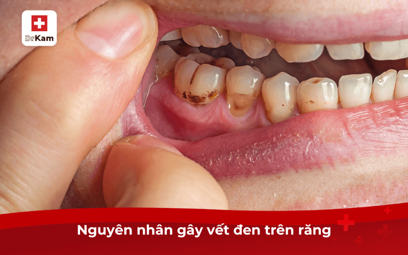 Răng có vết đen: Nguyên nhân, tác hại và 8 cách loại bỏ vết đen răng hiệu quả ngay 3 Nguyên nhân gây vết đen trên răng