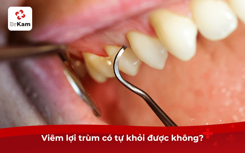 Tôi bị viêm lợi tự khỏi được không? Biện pháp điều trị dứt điểm hiệu quả 3 Viêm lợi trùm có tự khỏi được không?