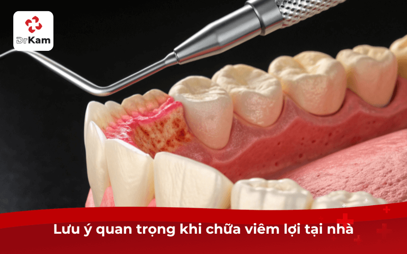 TOP 2 cách chữa viêm lợi tại nhà nhanh nhất, an toàn ngay lần đầu dùng 4 Lưu ý quan trọng khi chữa viêm lợi tại nhà