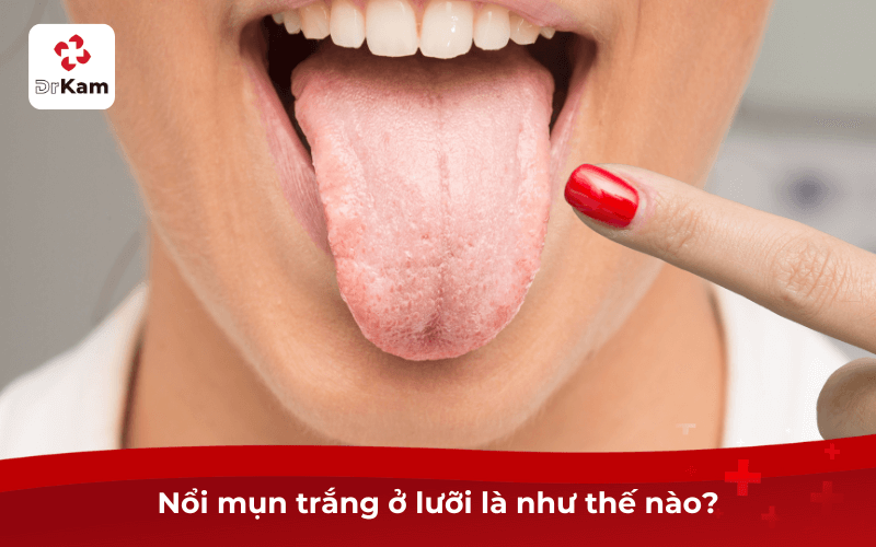 Nổi mụn trắng ở lưỡi là như thế nào?