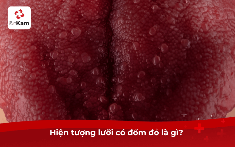 Tôi thấy lưỡi có đốm đỏ sao không? Nguyên nhân, mức độ nguy hiểm và cách khắc phục hiệu quả 3 Hiện tượng lưỡi có đốm đỏ là gì?
