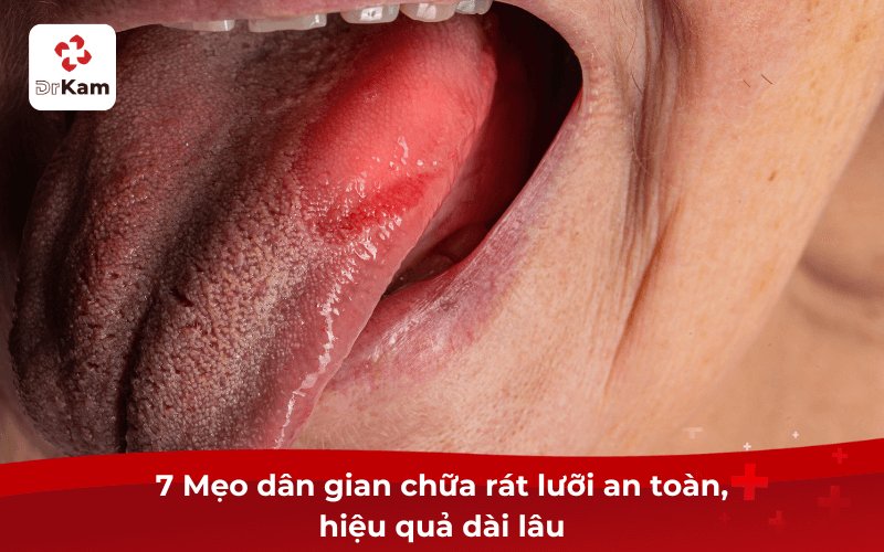 7 Mẹo dân gian chữa rát lưỡi an toàn, hiệu quả dài lâu