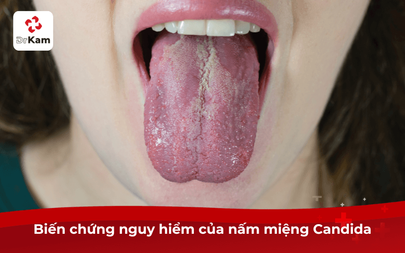 Biến chứng nguy hiểm của nấm miệng Candida