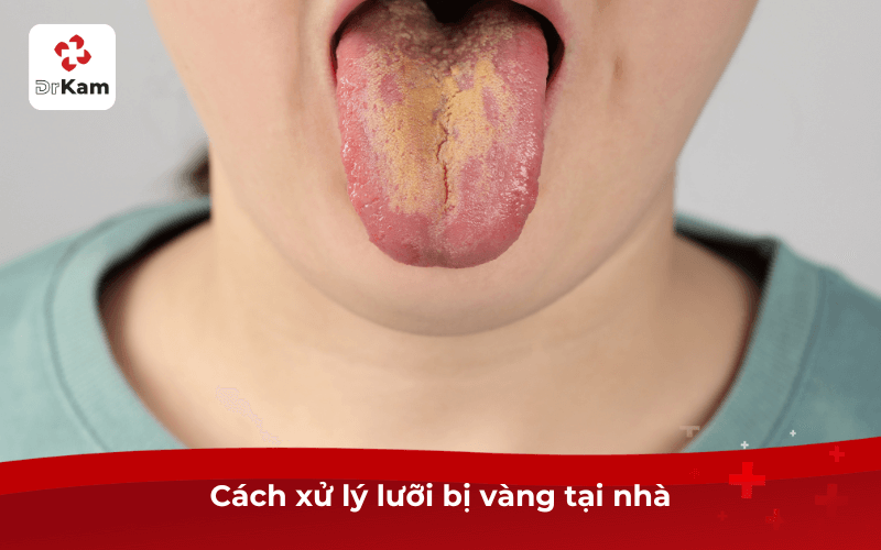 Cách xử lý lưỡi vàng tại nhà