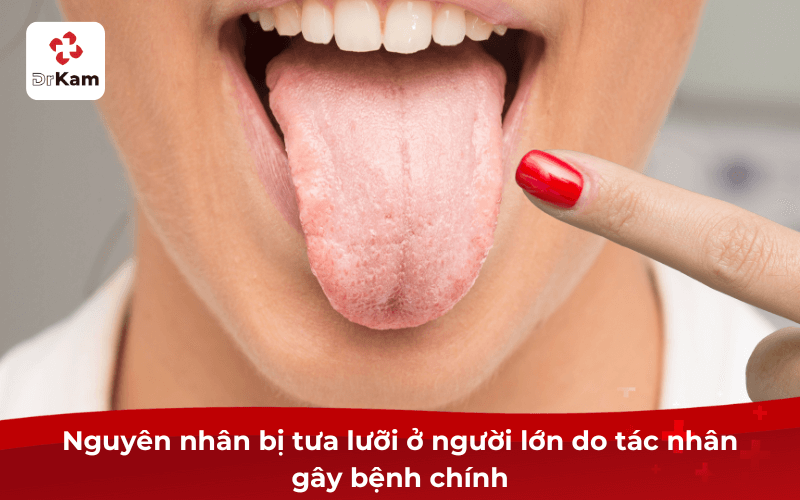Nguyên nhân bị tưa lưỡi ở người lớn do tác nhân gây bệnh chính