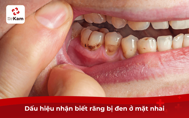 Con tôi răng bị đen ở mặt nhai có sao không? Dấu hiệu, nguyên nhân, cách xử lý hiệu quả 3 Dấu hiệu nhận biết răng bị đen ở mặt nhai