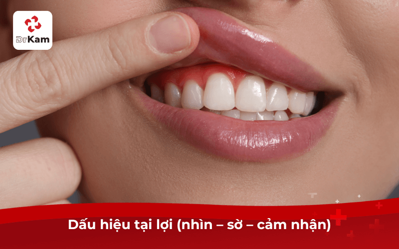Dấu hiệu tại lợi (nhìn – sờ – cảm nhận)
