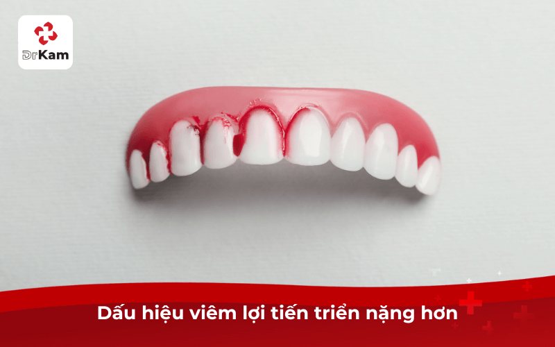 Dấu hiệu viêm lợi tiến triển nặng hơn