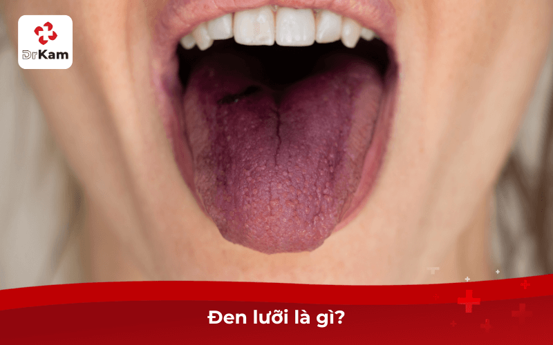 Con tôi bị đen lưỡi có sao không? Nguyên nhân, triệu chứng và cách xử lý an toàn hiệu quả 3 Đen lưỡi là gì?