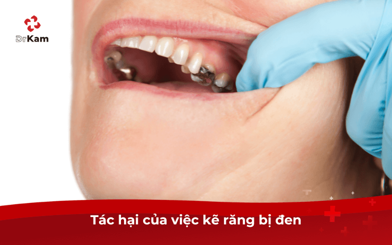 Kẽ răng bị đen tôi phải làm sao? Nguyên nhân, tác hại và cách xử lý hiệu quả 3 Tác hại của việc kẽ răng bị đen