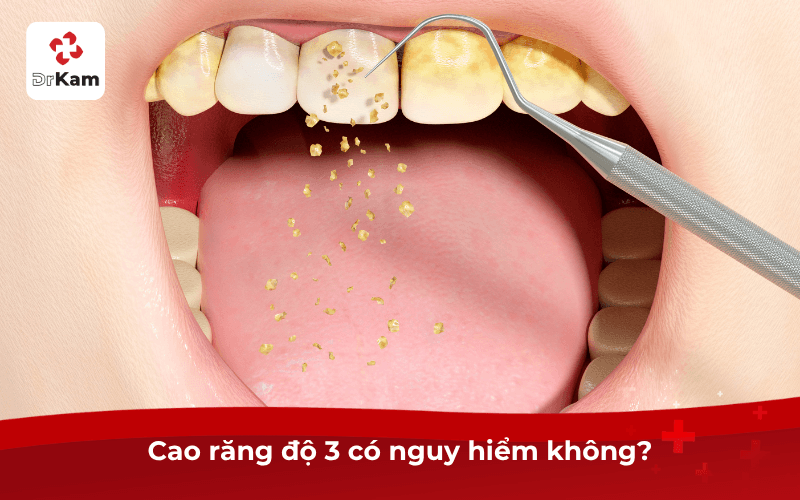 Con tôi cao răng độ 3 có sao không? Tác hại, cách xử lý và phòng ngừa cao răng hiệu quả 3 Cao răng độ 3 có nguy hiểm không?