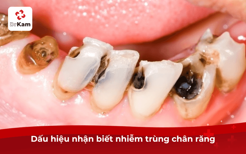Dấu hiệu nhận biết nhiễm trùng chân răng