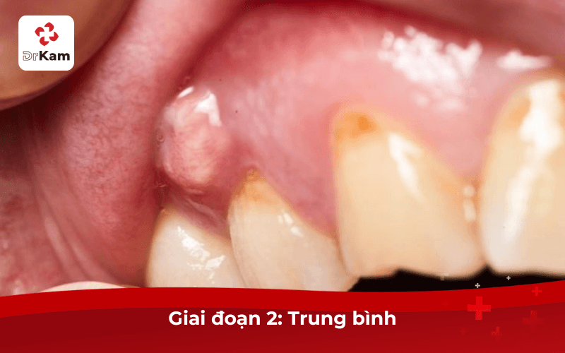 Sưng Mộng Răng Giai Đoạn 2