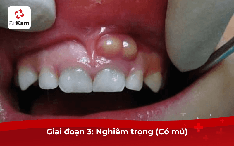 Sưng Mộng Răng Giai Đoạn 3