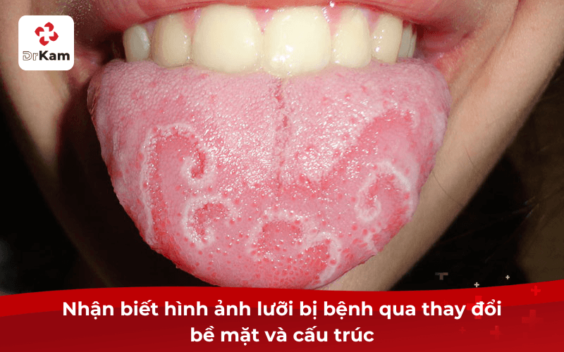 Thực tế hình ảnh lưỡi bị bệnh cha mẹ cần biết để xử lý kịp thời cho bé 4 Nhận biết hình ảnh lưỡi bị bệnh qua thay đổi bề mặt và cấu trúc