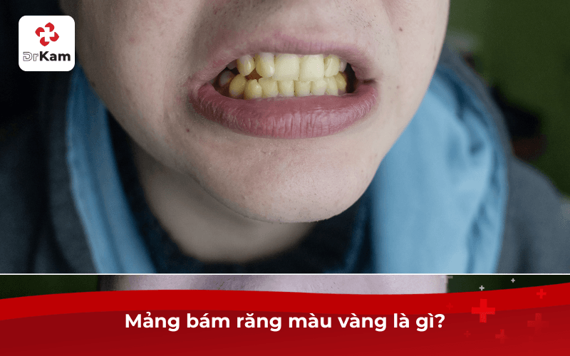 Mảng bám răng màu vàng là gì?