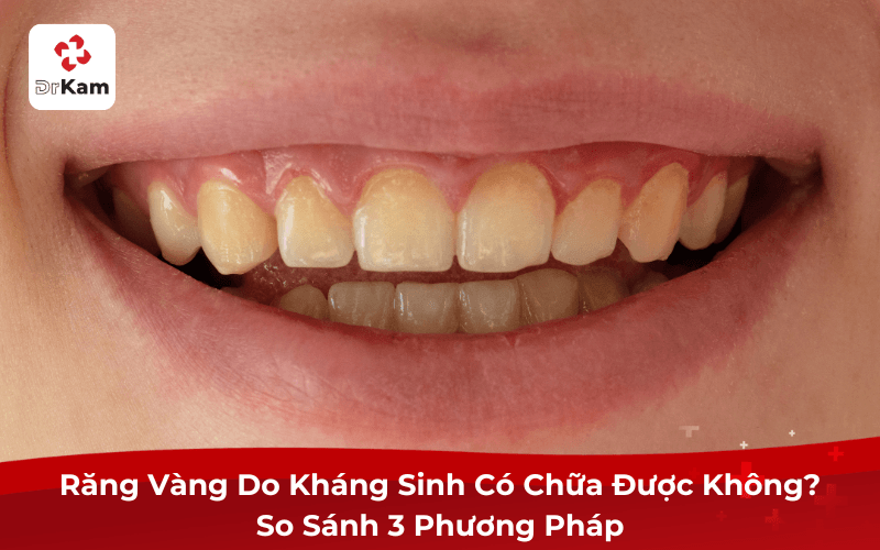 Răng Vàng Do Kháng Sinh Có Chữa Được Không? So Sánh 3 Phương Pháp