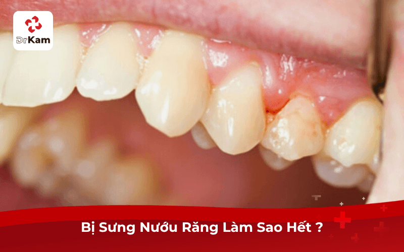Bị Sưng Nướu Răng Làm Sao Hết ?