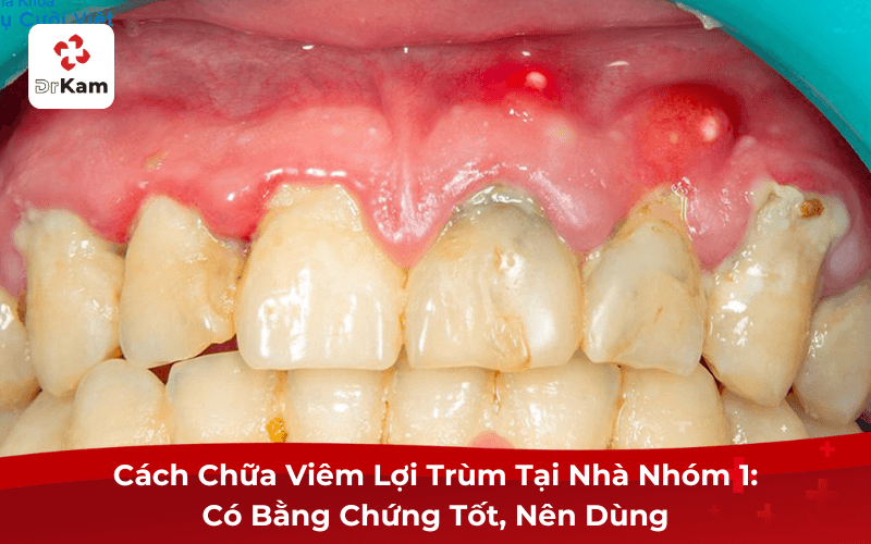 Cách Chữa Viêm Lợi Trùm Tại Nhà Nhóm 1
