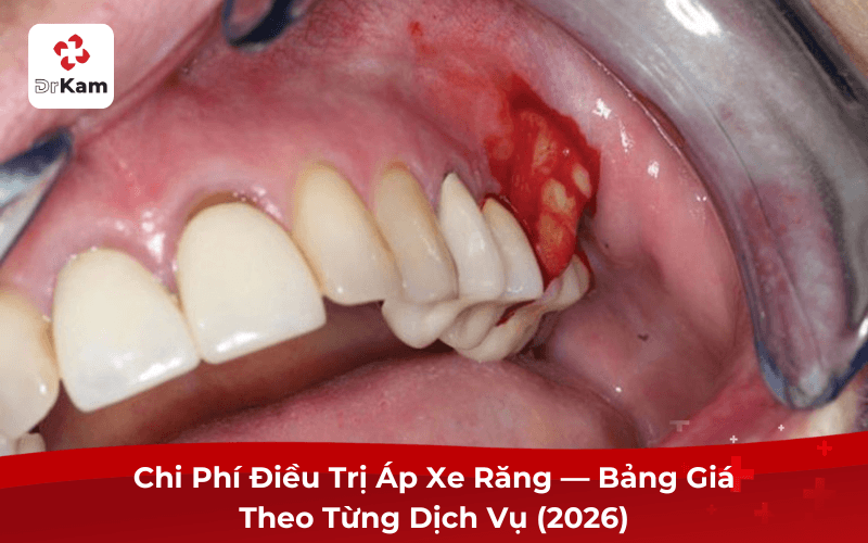Chi Phí Điều Trị Áp Xe Răng — Bảng Giá Theo Từng Dịch Vụ (2026)