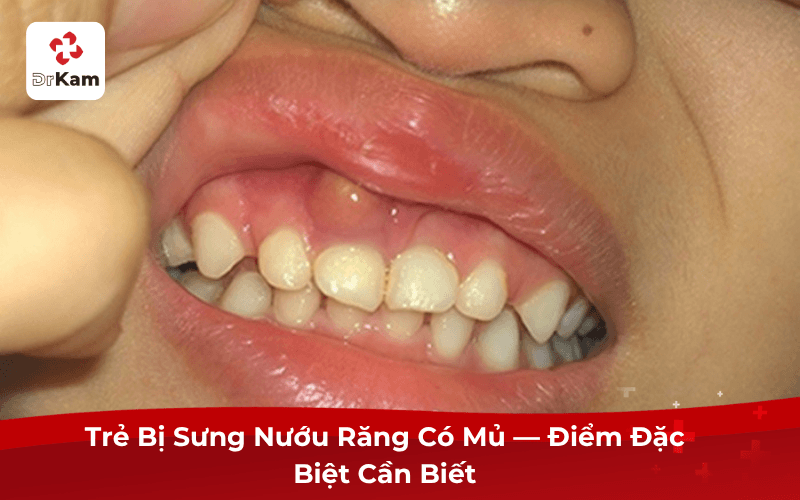 Trẻ Bị Sưng Nướu Răng Có Mủ — Điểm Đặc Biệt Cần Biết