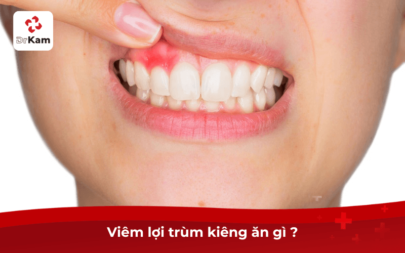 Viêm Lợi Trùm Kiêng Ăn Gì?