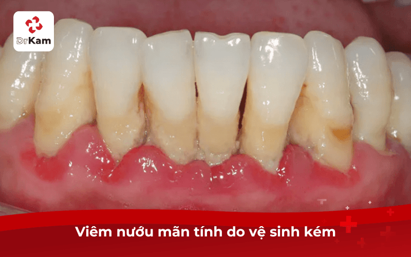 Viêm nướu mãn tính do vệ sinh kém