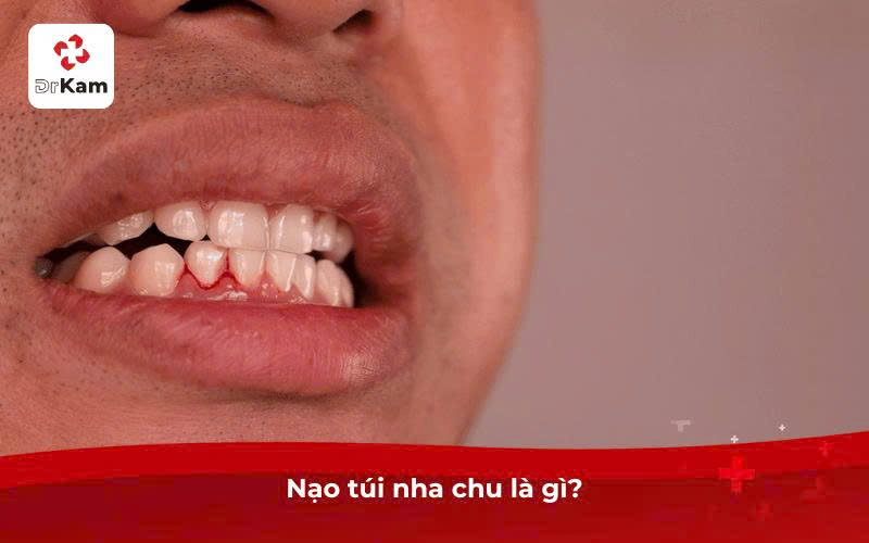 Nạo túi nha chu là gì?