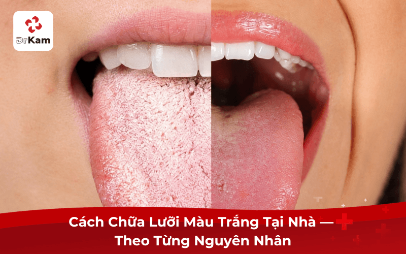 Cách Chữa Lưỡi Màu Trắng Tại Nhà
