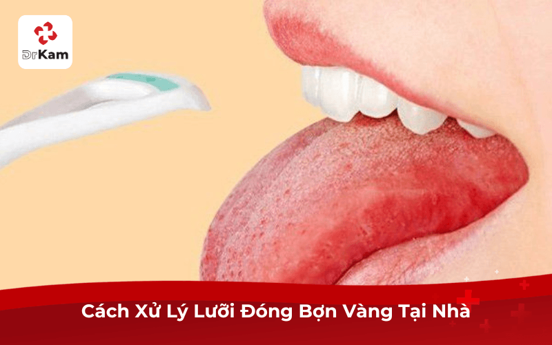 Cách Xử Lý Lưỡi Đóng Bợn Vàng Tại Nhà