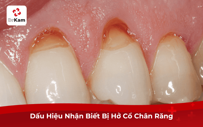Dấu Hiệu Nhận Biết Bị Hở Cổ Chân Răng
