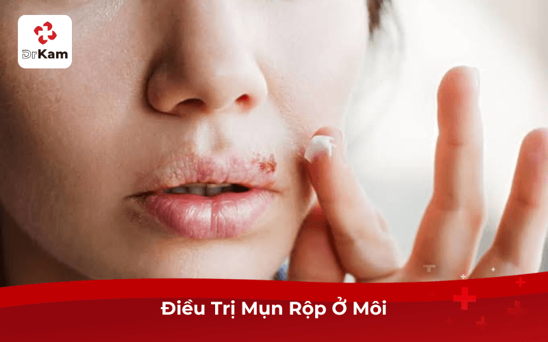Điều Trị Mụn Rộp Ở Môi