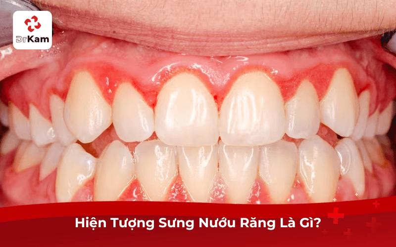 Hiện Tượng Bệnh Sưng Nướu Răng Là Gì?