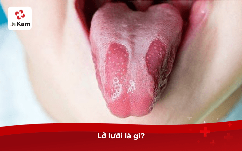 Lở lưỡi là gì?