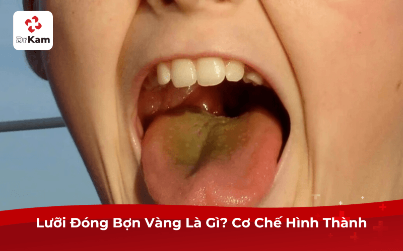 Lưỡi Đóng Bợn Vàng Là Gì? Cơ Chế Hình Thành