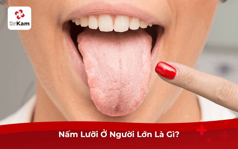 Nấm Lưỡi Ở Người Lớn Là Gì?