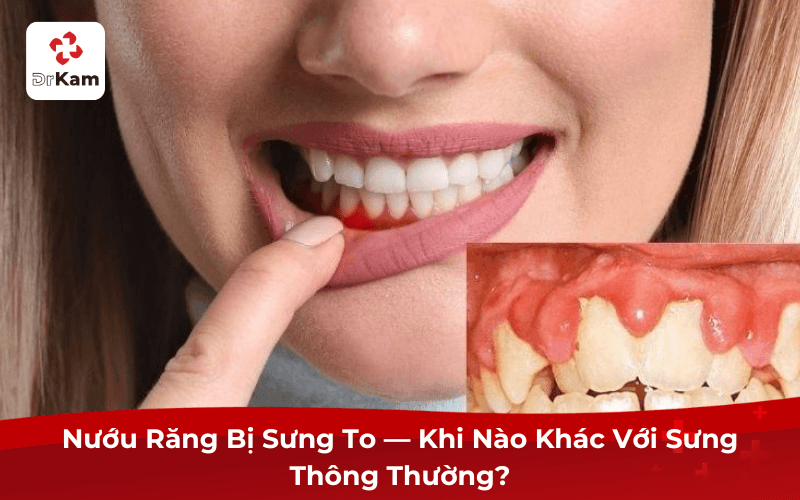 Nướu Răng Bị Sưng To — Khi Nào Khác Với Sưng Thông Thường?