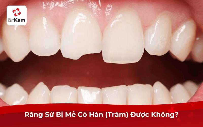 Răng Sứ Bị Mẻ Có Hàn (Trám) Được Không?
