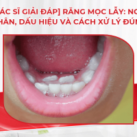 [Bác sĩ giải đáp] Răng mọc lẫy: Nguyên nhân, dấu hiệu và cách xử lý đúng