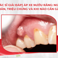 [Bác sĩ giải đáp] Áp xe nướu răng: Nguyên nhân, triệu chứng và khi nào cần gặp bác sĩ