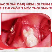 [Bác sĩ giải đáp] Viêm lợi trùm bao lâu thì khỏi? 3 mốc thời gian thực tế