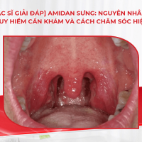 [Bác sĩ giải đáp] Amidan sưng: Nguyên nhân, dấu hiệu nguy hiểm cần khám và cách chăm sóc hiệu quả