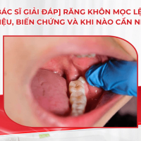 [Bác sĩ giải đáp] Răng khôn mọc lệch: Dấu hiệu, biến chứng và khi nào cần nhổ
