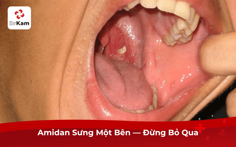 Amidan Sưng Một Bên — Đừng Bỏ Qua