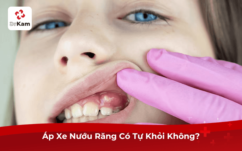 Áp Xe Nướu Răng Có Tự Khỏi Không?