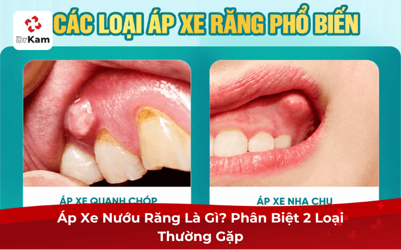 Áp Xe Nướu Răng Là Gì? Phân Biệt 2 Loại Thường Gặp