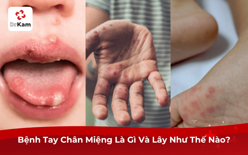 Bệnh Tay Chân Miệng Là Gì Và Lây Như Thế Nào?